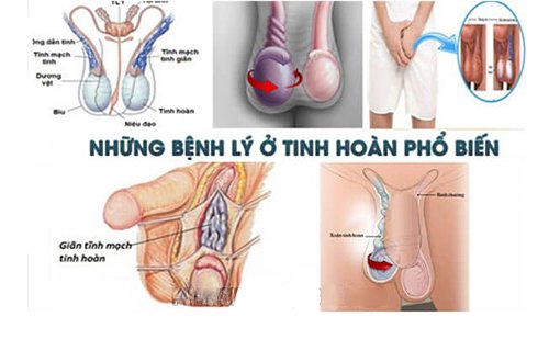 cac-benh-ly-tinh-hoan-o-nam-gioi