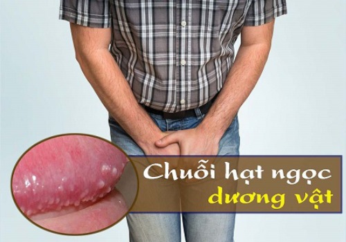 chuỗi hạt ngọc dương vật