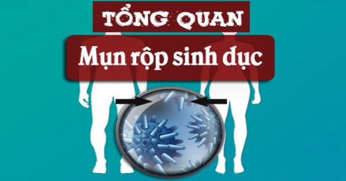 tổng quan mụn rộp sinh dục