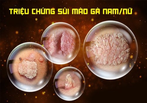 triệu chứng bệnh sùi mào gà