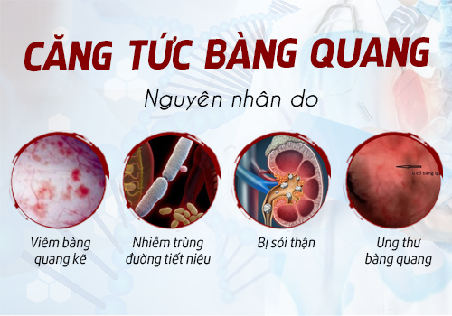 nguyên nhân gây căng tức bàng quang